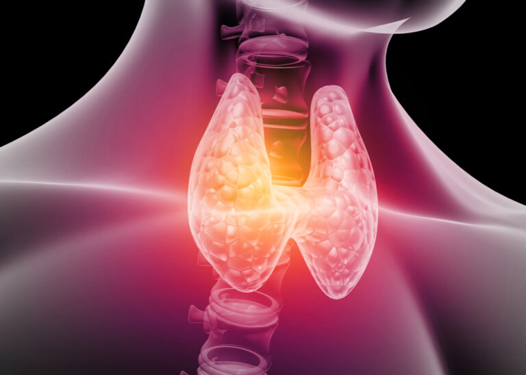 Thyroid flare